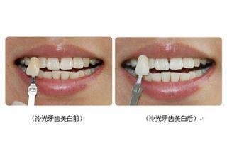 爆料牙齿美白是真的吗视频,视频爆料揭示真实效果